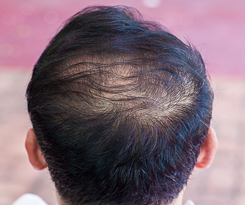 Common Causes of Hair Thinning